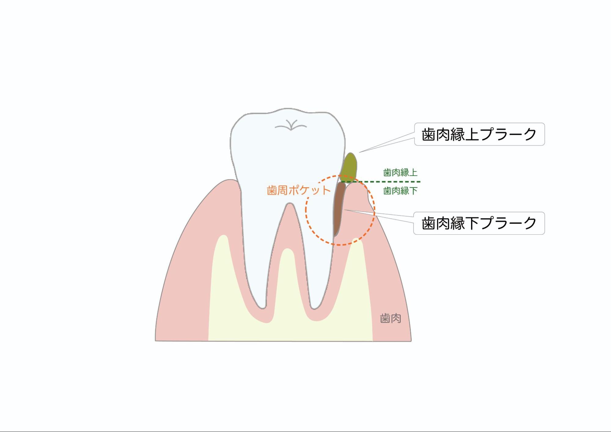 歯垢（プラーク）とは｜歯石との違いは？歯垢がつきやすい人や簡単な取り方｜wakanote