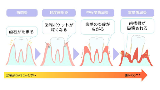 【歯周病の歯肉炎とは?】歯肉炎の症状や原因・歯周炎との違いについて解説|wakanote