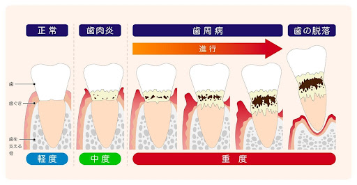 歯周病の症状とは？歯周病になる原因や進行度合い別の特徴を詳しく解説