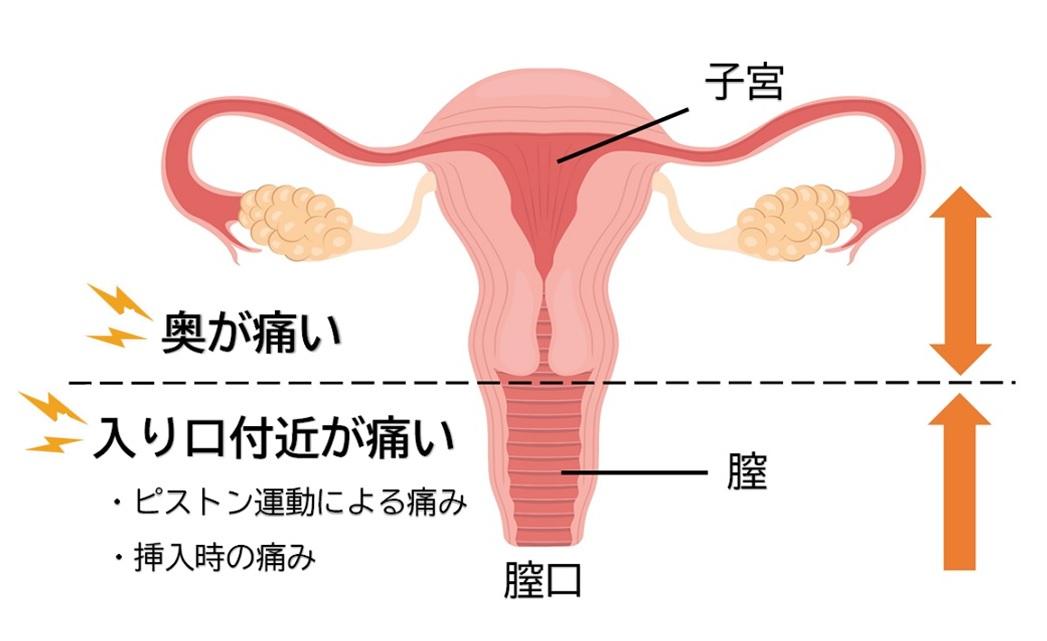 性交痛がつらい…セックス（挿入時）の痛みの原因と我慢しないための対策｜wakanote