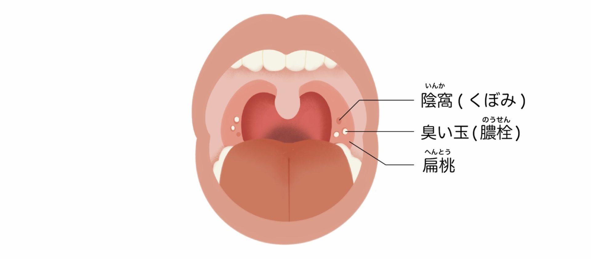 口臭の原因になる臭い玉（膿栓）とは？取り方や予防方法を解説！｜wakanote
