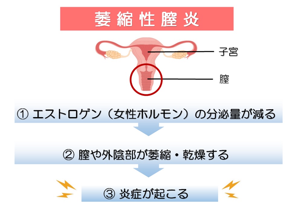 萎縮性膣炎とは？更年期以降になりやすい原因や症状・治療法について解説！｜wakanote