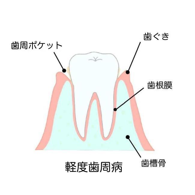 歯周病の治し方は？一般的な歯周病治療の方法と自分で治す方法について
