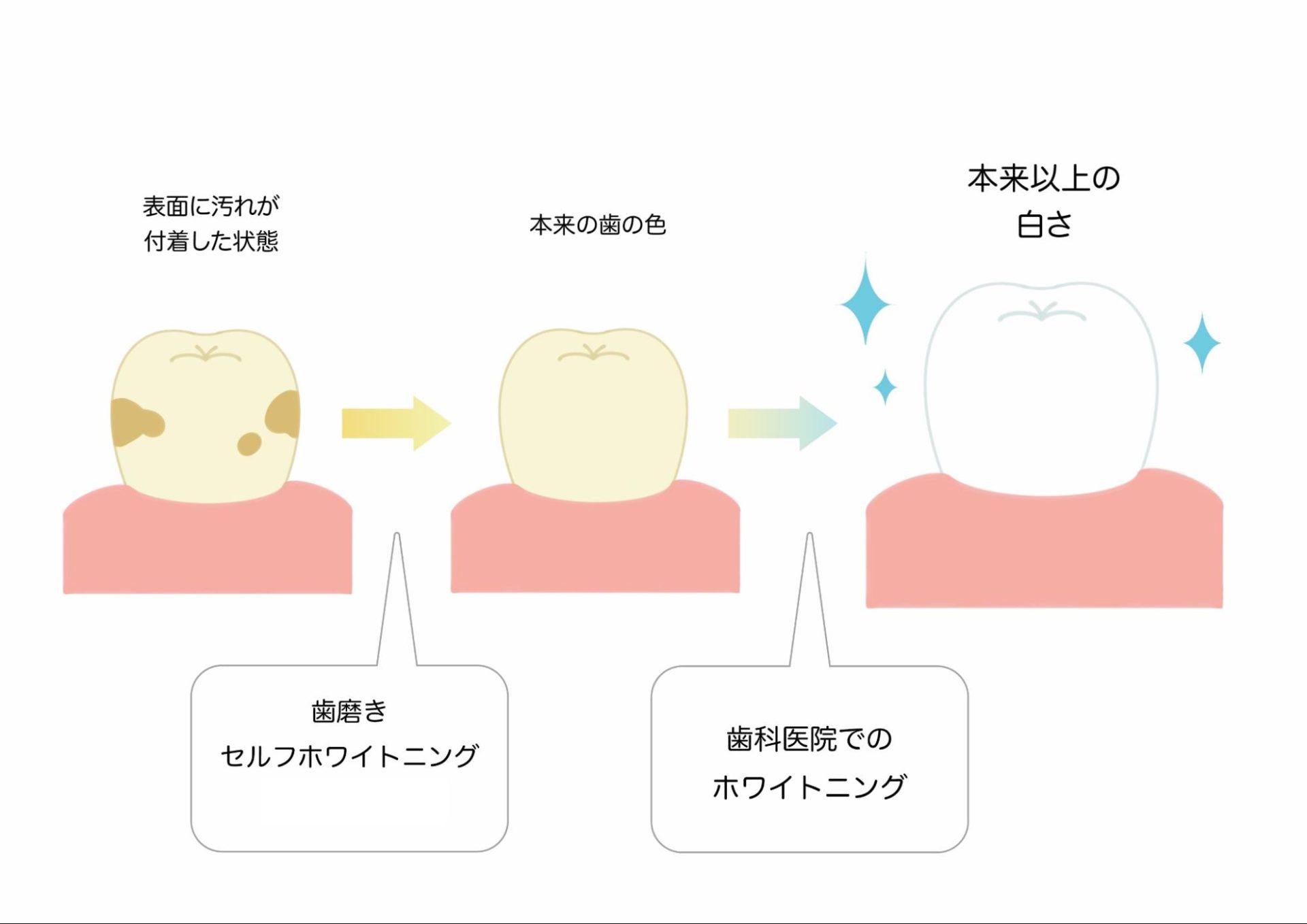 家 で 歯 を 白く する 方法: 歯に塗るだけで白くなる _ 塩と重曹と竹炭で歯磨き粉を手 …