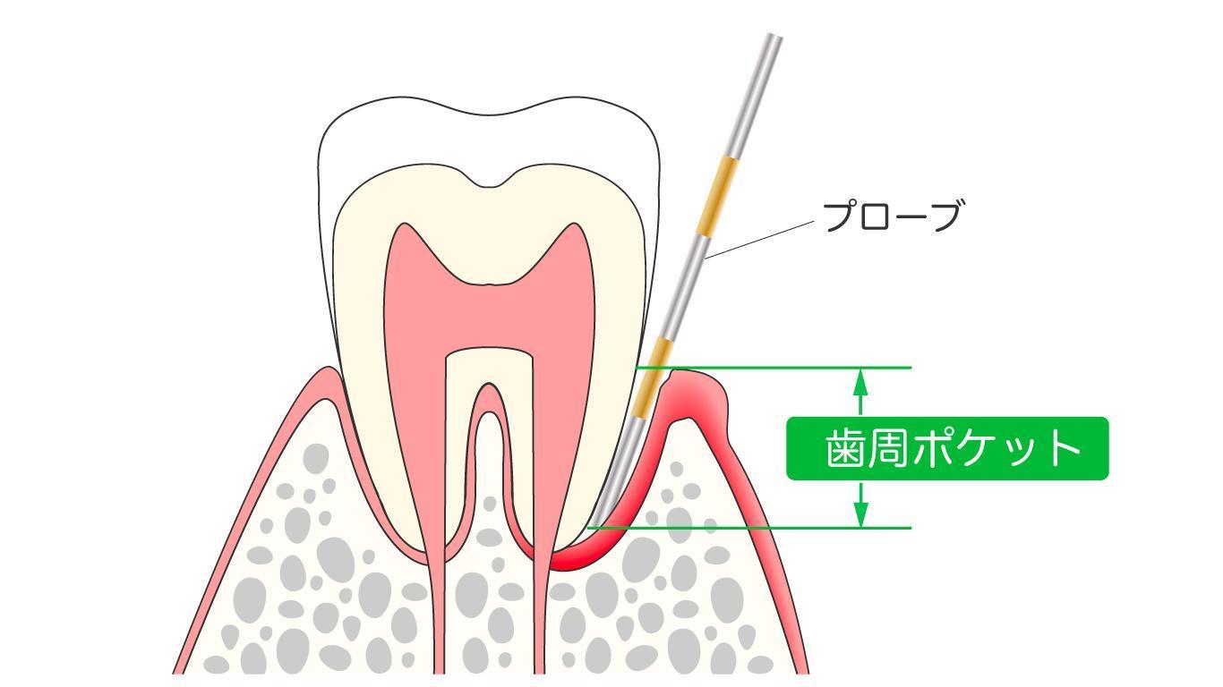 歯周病の治し方は？一般的な歯周病治療の方法と自分で治す方法について
