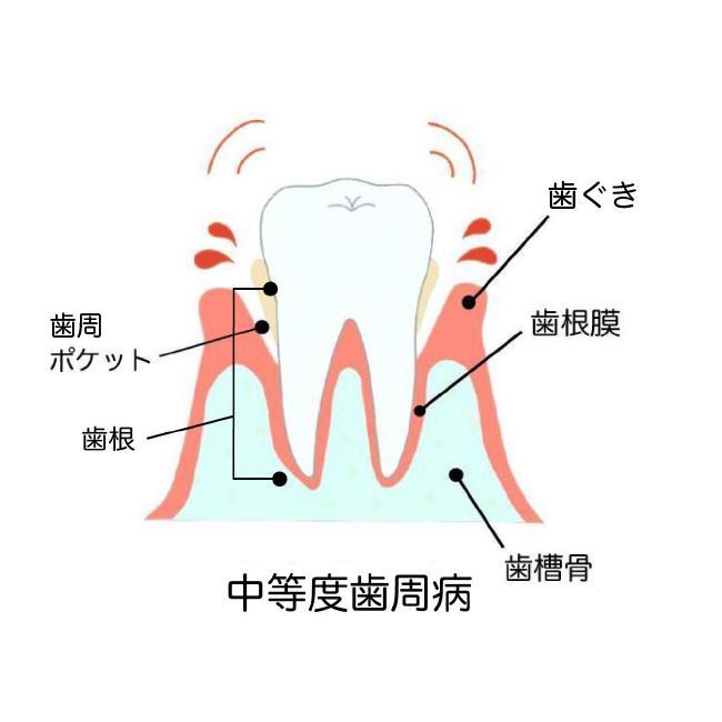 歯周病の治し方は？一般的な歯周病治療の方法と自分で治す方法について