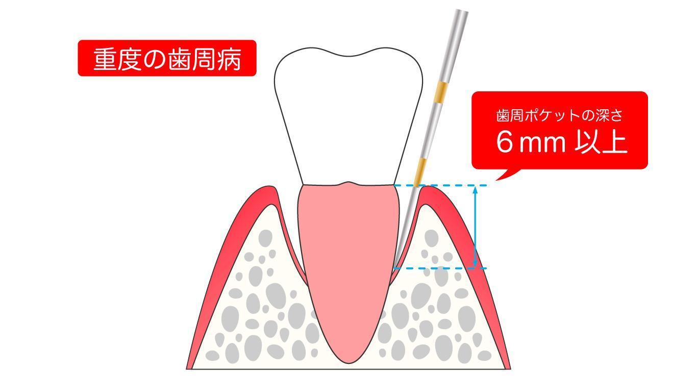 歯周ポケット 深さ 4mm – 歯周ポケット 4mm 30代 – HIUCC